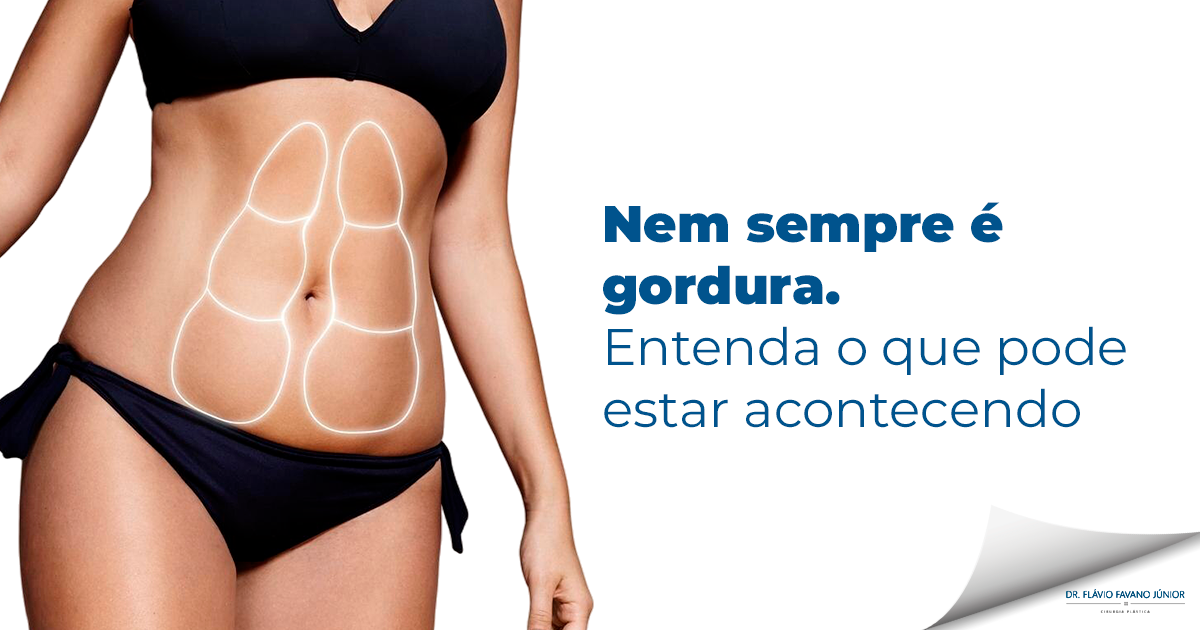 Diástase abdominal: quando é necessário corrigir com cirurgia?